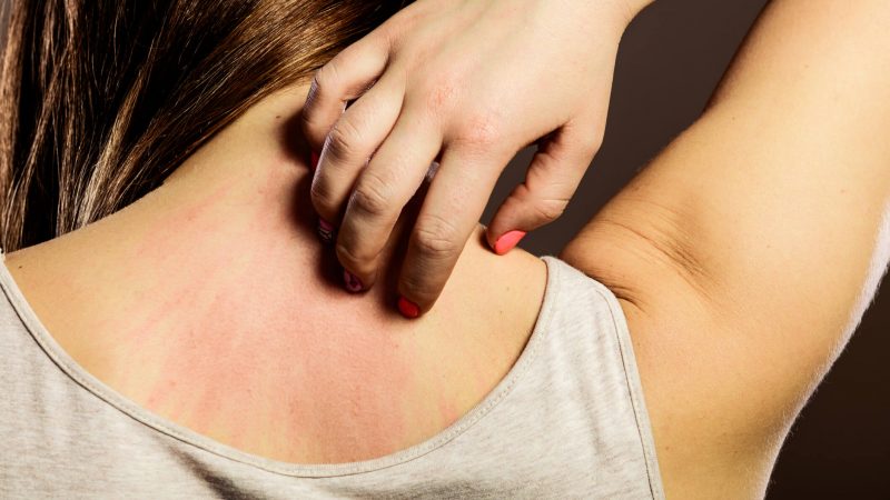 Alergias de pele: conheça as mais comuns no verão
